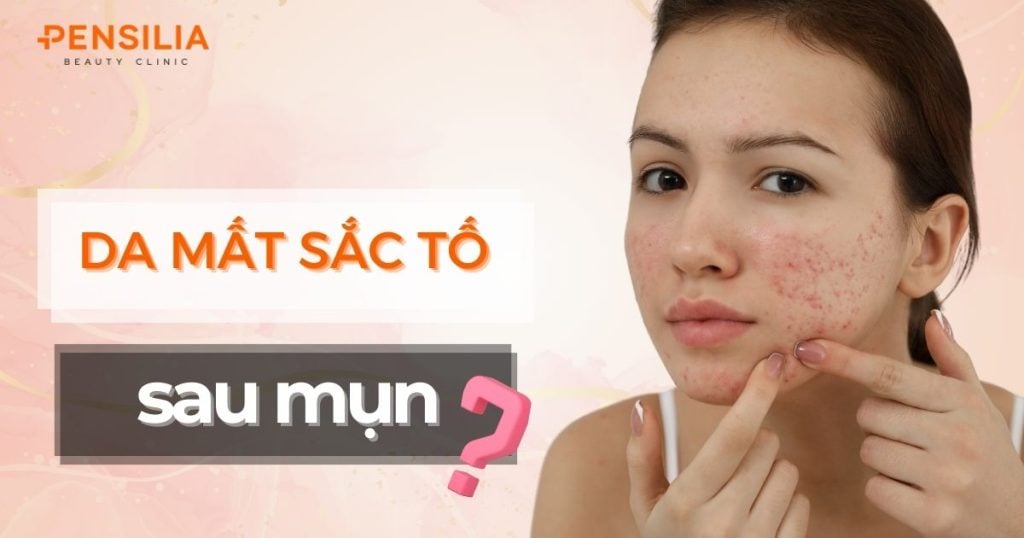 Da mất sắc tố sau mụn: Nguyên nhân và cách xử lý