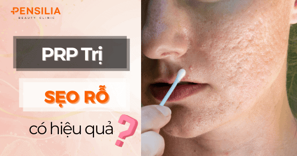 Khám phá hiệu quả của PRP trong điều trị sẹo rỗ an toàn