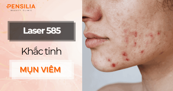 Laser 585 trị mụn: Giải pháp tối ưu cho mụn viêm và mụn đỏ