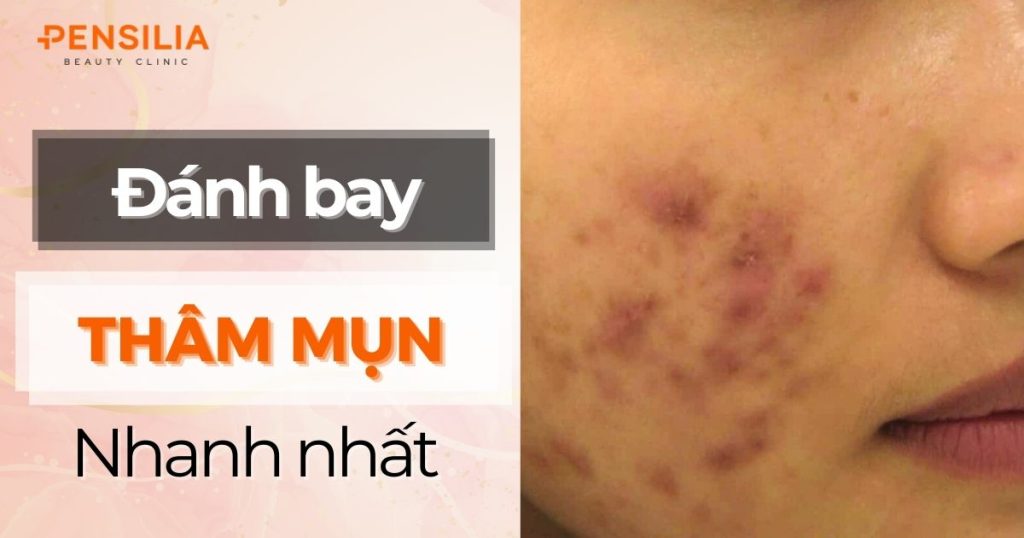 Đánh Bay Vết Thâm Mụn Nhanh Nhất