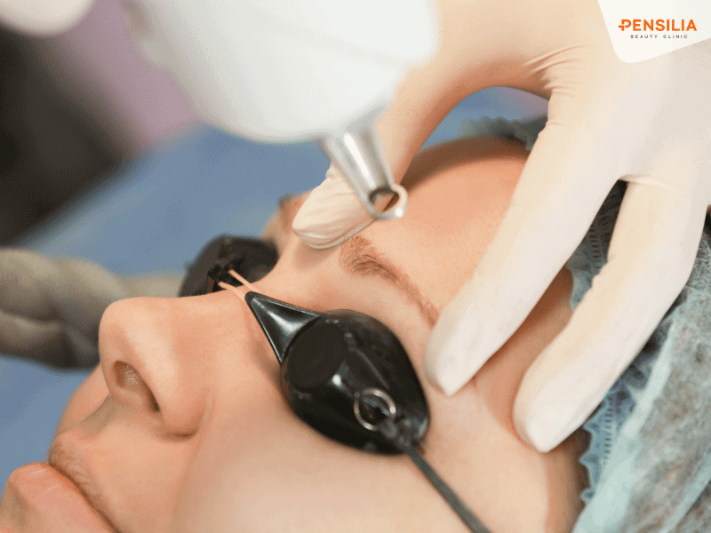 Xóa xăm chân mày bằng laser không đau, không để lại sẹo