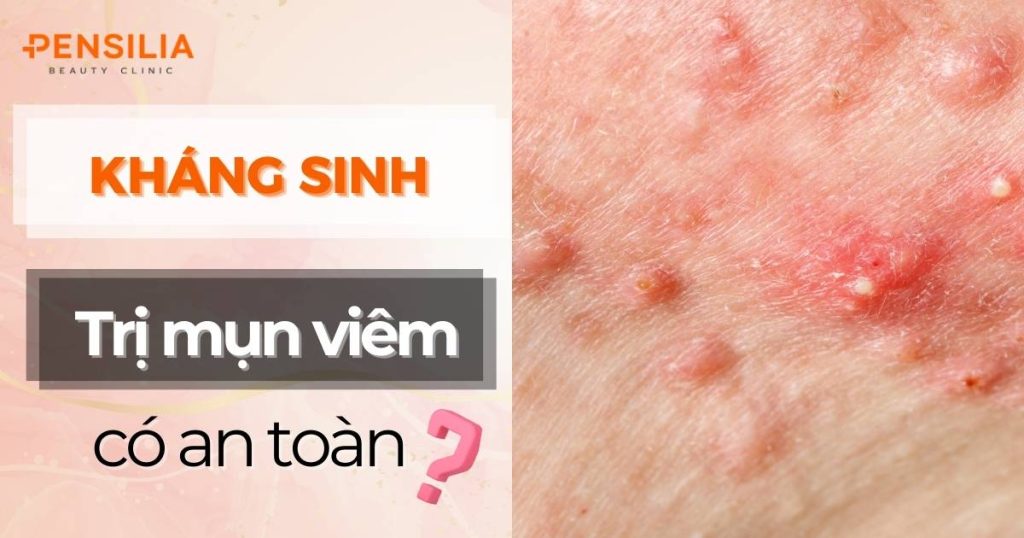 Kháng sinh trị mụn viêm có an toàn