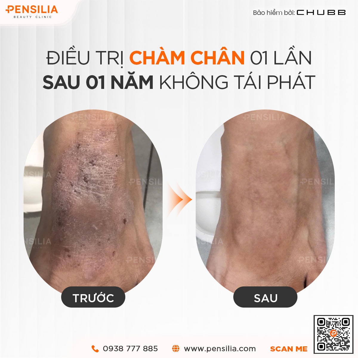 Khách hàng sau điều trị 1 lần chàm chân tại Pensilia 