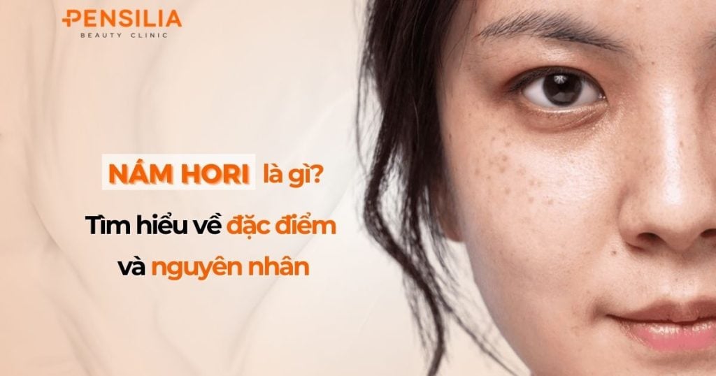 Nám Hori là gì Tìm hiểu về đặc điểm và nguyên nhân