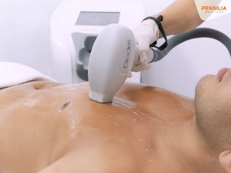 Công nghệ Laser 3 tia