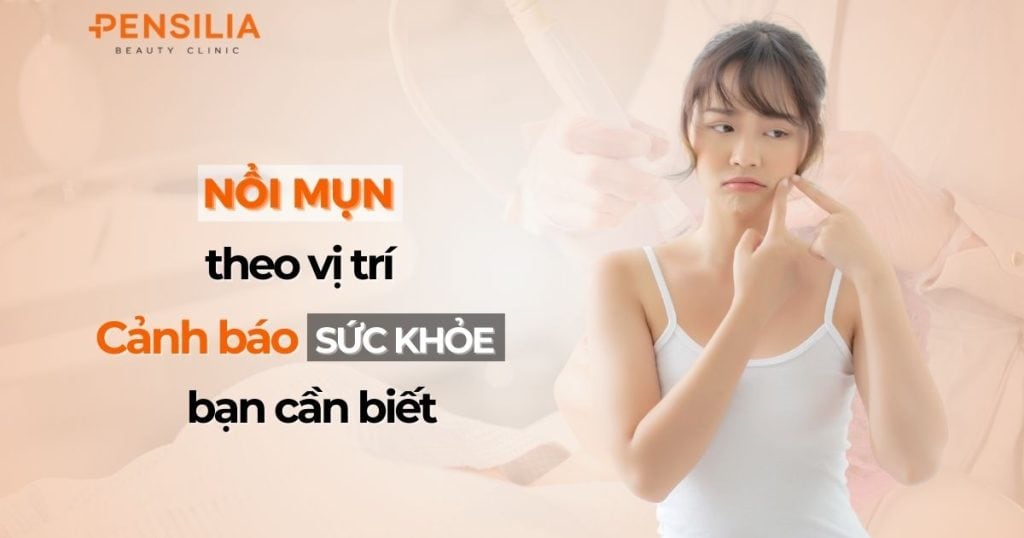 Nổi mụn theo vị trí