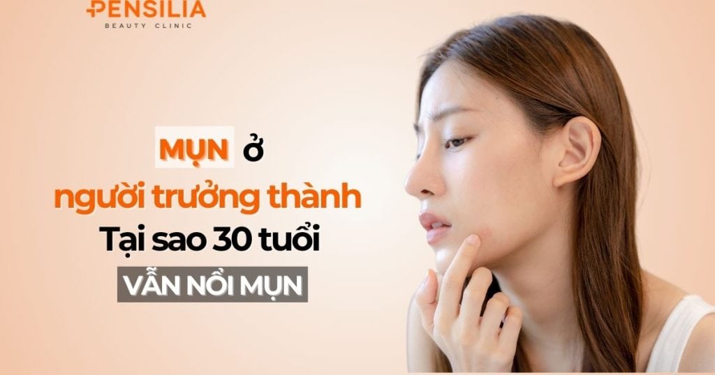 Mụn ở người trưởng thành: Tại sao 30 tuổi vẫn nổi mụn?