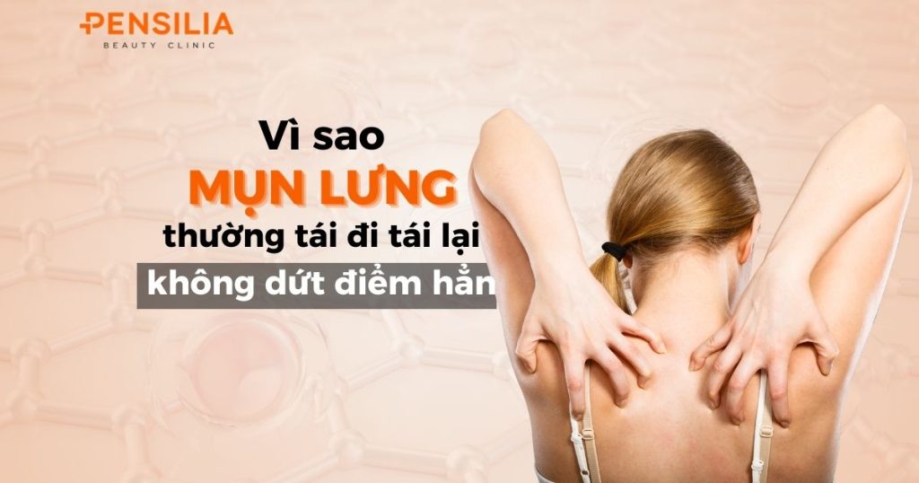 Vì sao mụn lưng tái đi tái lại nhiều lần