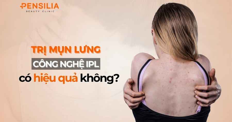 Trị mụn lưng bằng công nghệ IPL có hiệu quả không?