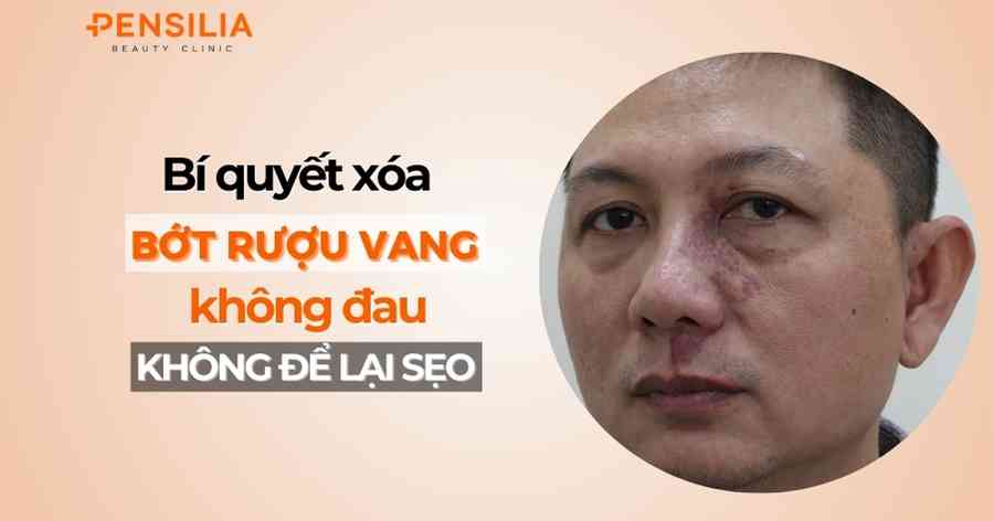 Xóa bớt rượu vang không đau, không để lại sẹo