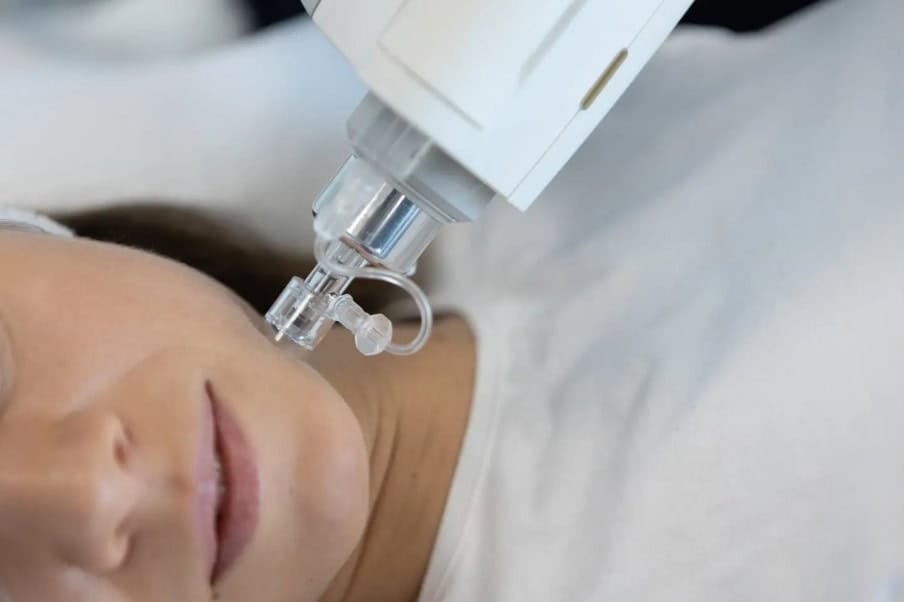 cắt đáy sẹo rỗ bằng khí tại pensilia hồ chí minh