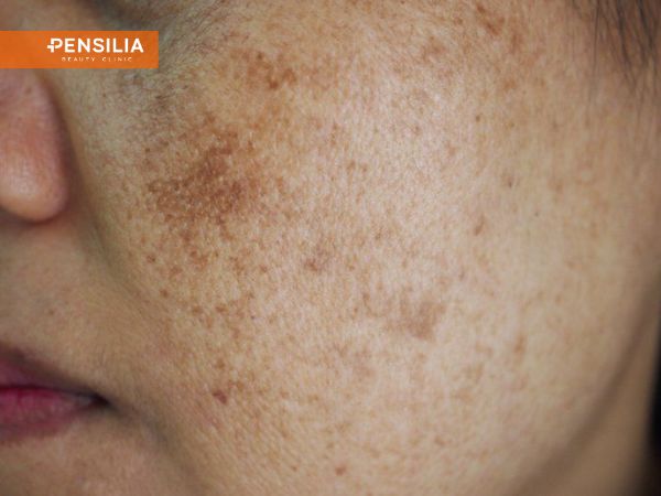 Nám gò má ở phụ nữ từ 30 đến 55 tuổi