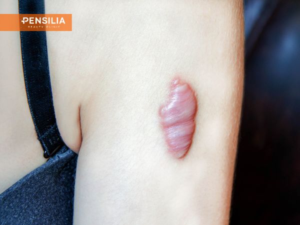 Vết sẹo lồi nổi gồ trên da tay sau tổn thương, thường được áp dụng mẹo chữa sẹo lồi dân gian