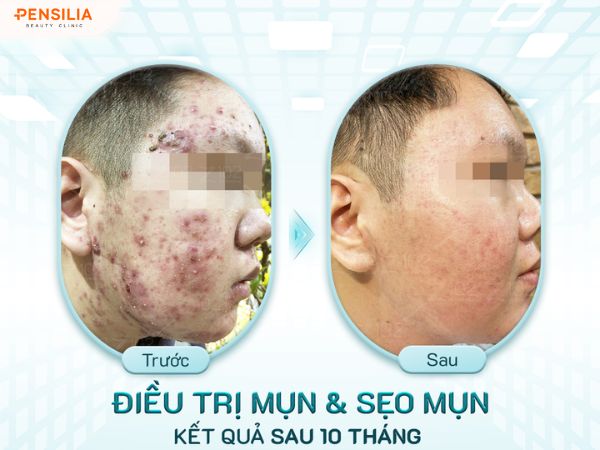 Hình ảnh sẹo rỗ vùng má cải thiện rõ rệt sau liệu trình điều trị tại Pensilia