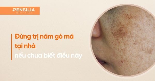 các cách trị nám gò má tại nhà từ y khoa