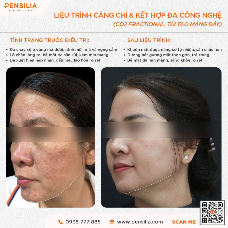 Kết quả trước sau công nghệ trẻ hóa da tại phòng khám Pensilia TP.HCM