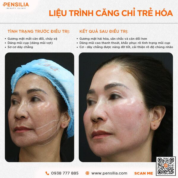 kết quả trước sau căng chỉ da mặt tại phòng khám Pensilia TP.HCM – nâng cơ định hình đường nét