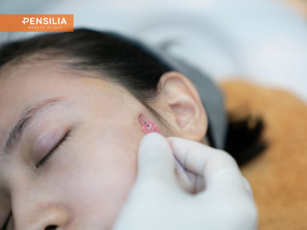 giá căng chỉ da mặt – bác sĩ thực hiện thao tác căng chỉ sinh học PDO nâng cơ mặt tại phòng khám