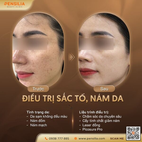 Kết quả trước và sau khi điều trị nám da bằng phác đồ kết hợp peel da và laser Picosure Pro tại Pensilia.
