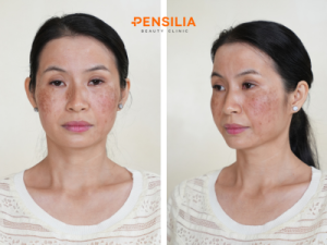 Tình trạng da của khách hàng trước khi điều trị tại PENSILIA