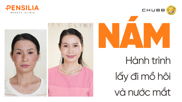 Hành trình điều trị Nám tại PENSILIA Nguyễn Đình Chiểu, quận 3