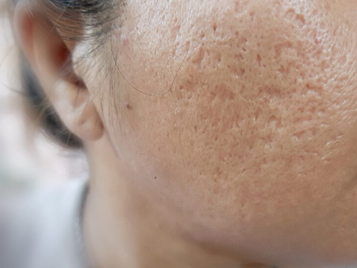 Vì sao các ca sẹo rỗ phức tạp cần phải bóc tách chân sẹo?