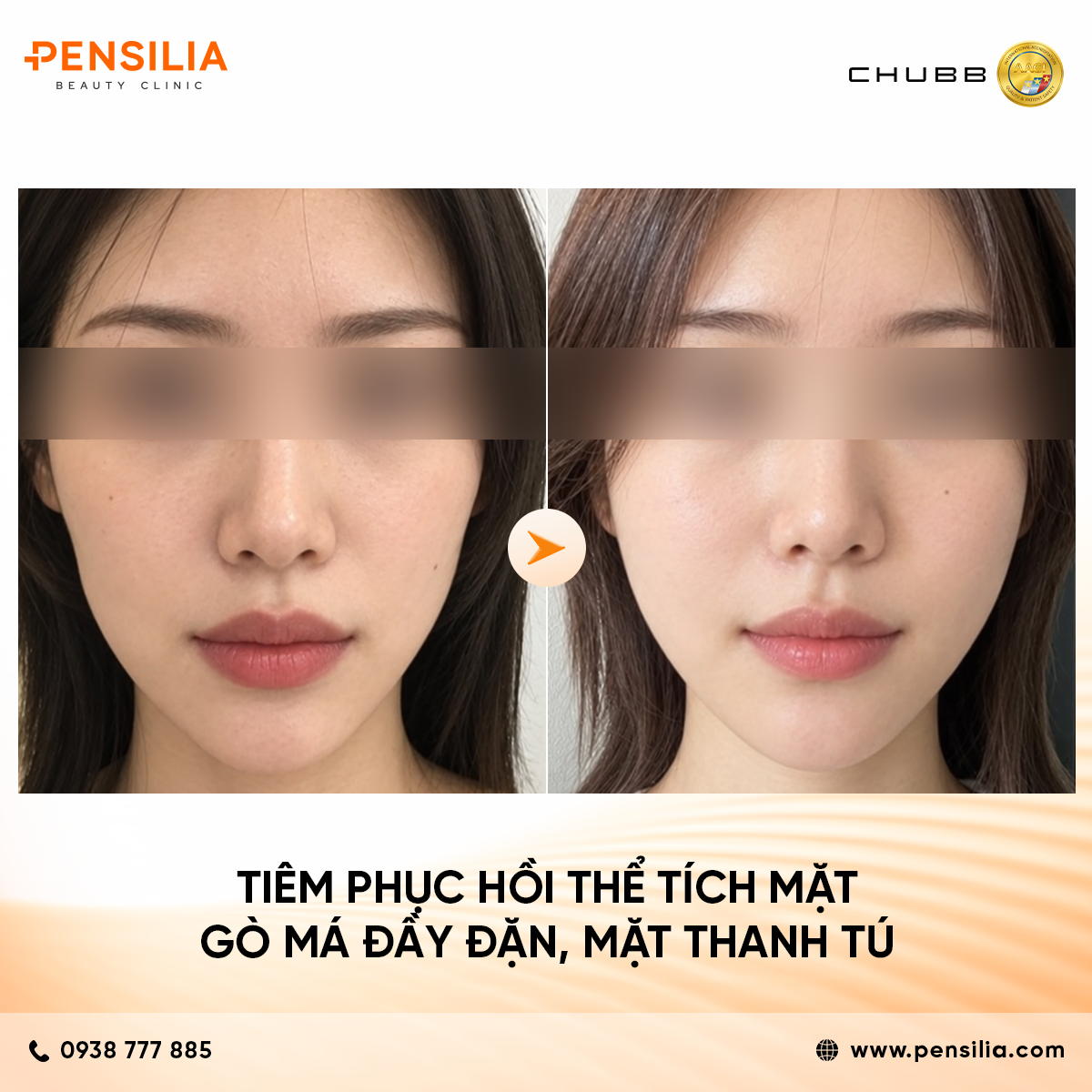 tiêm phục hồi thể tích mặt AESTHEFILL (PDLLA) – GIẢI PHÁP TRẺ HÓA DA VÀ ĐIỀU TRỊ SẸO LÕM TOÀN DIỆN