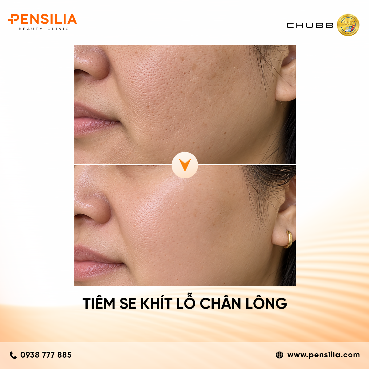 before after tiêm se khít lỗ chân lông