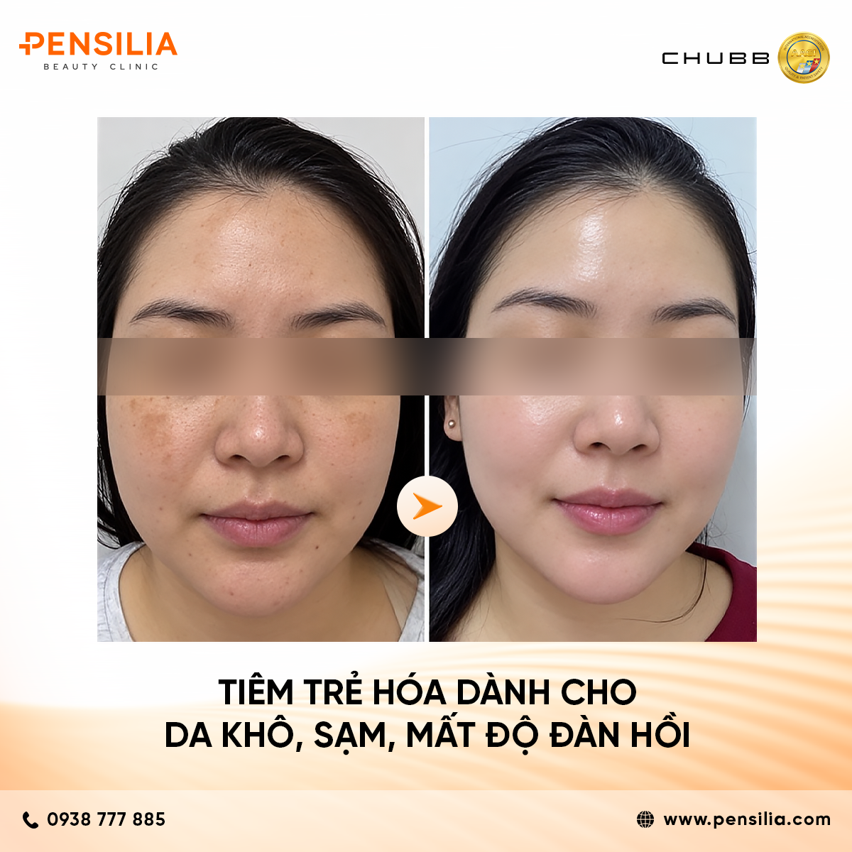 tiêm trẻ hoá AESTHEFILL (PDLLA) – GIẢI PHÁP TRẺ HÓA DA VÀ ĐIỀU TRỊ SẸO LÕM TOÀN DIỆN