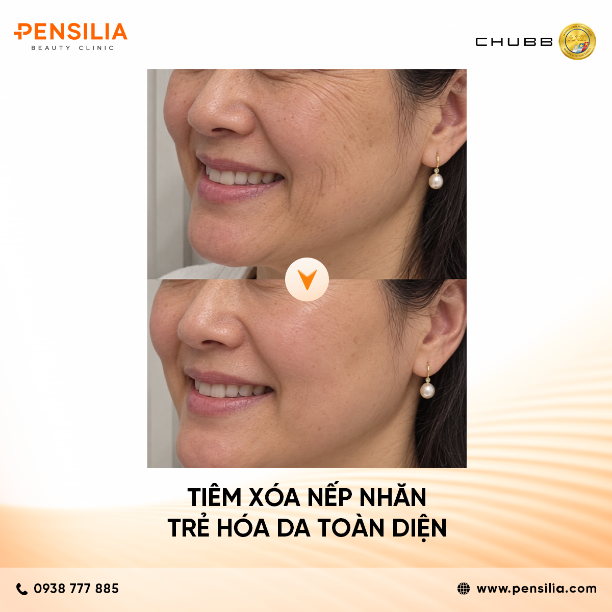 tiêm xoá nhăn AESTHEFILL (PDLLA) – GIẢI PHÁP TRẺ HÓA DA VÀ ĐIỀU TRỊ SẸO LÕM TOÀN DIỆN