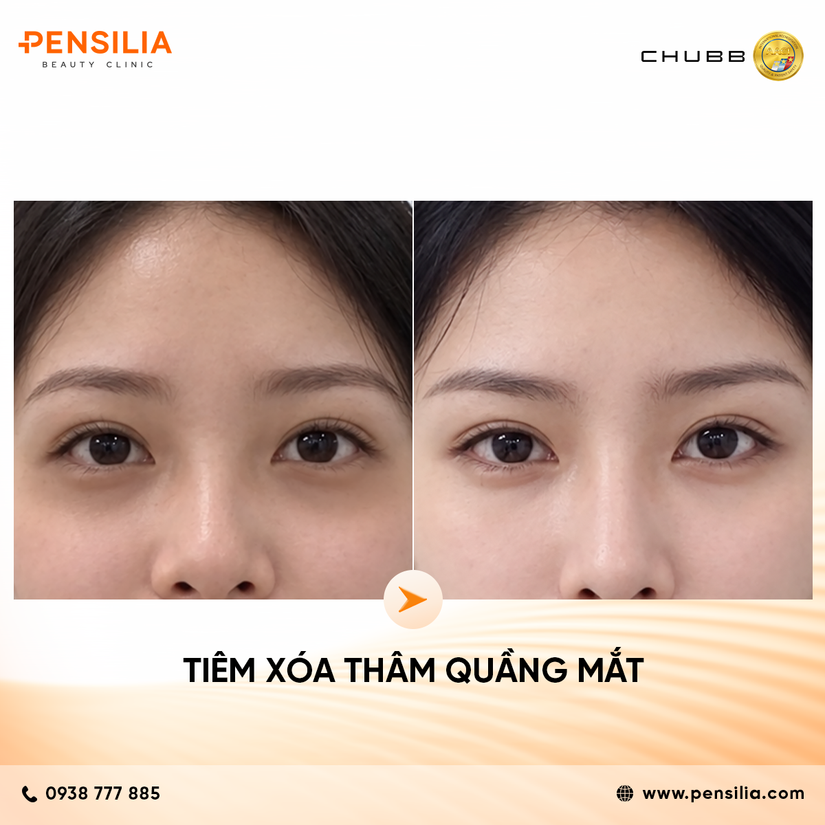 before after tiêm xoá thâm mắt