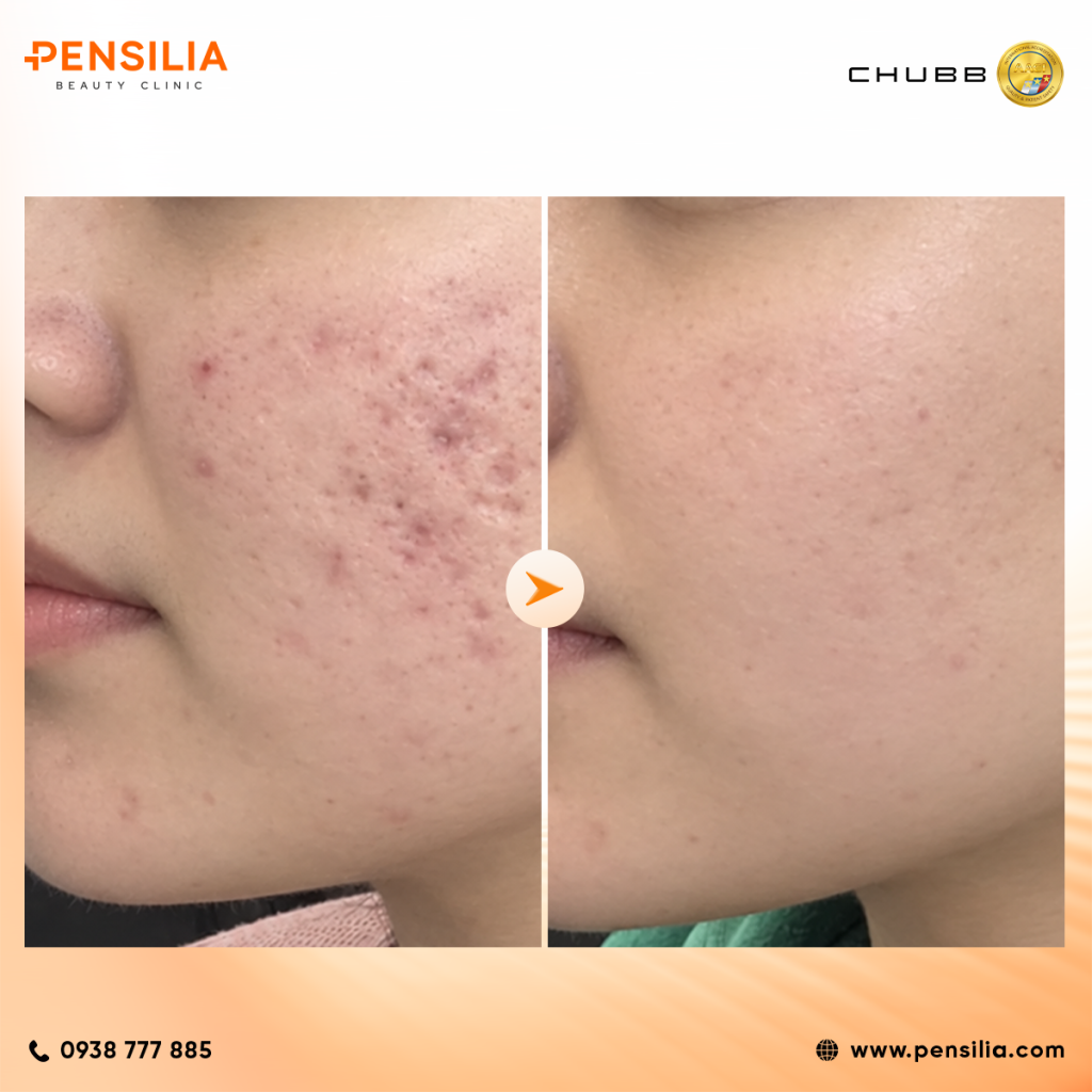 Collagen LineRase da hư tổn điều trị sau laser