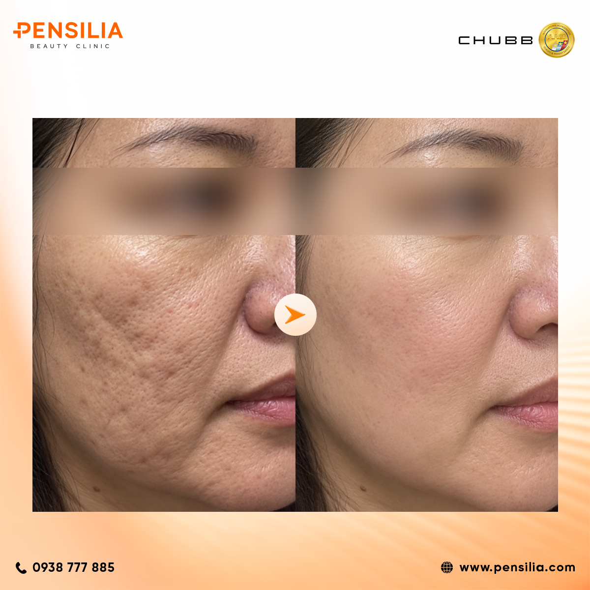 Collagen LineRase sẹo lõm sau điều trị