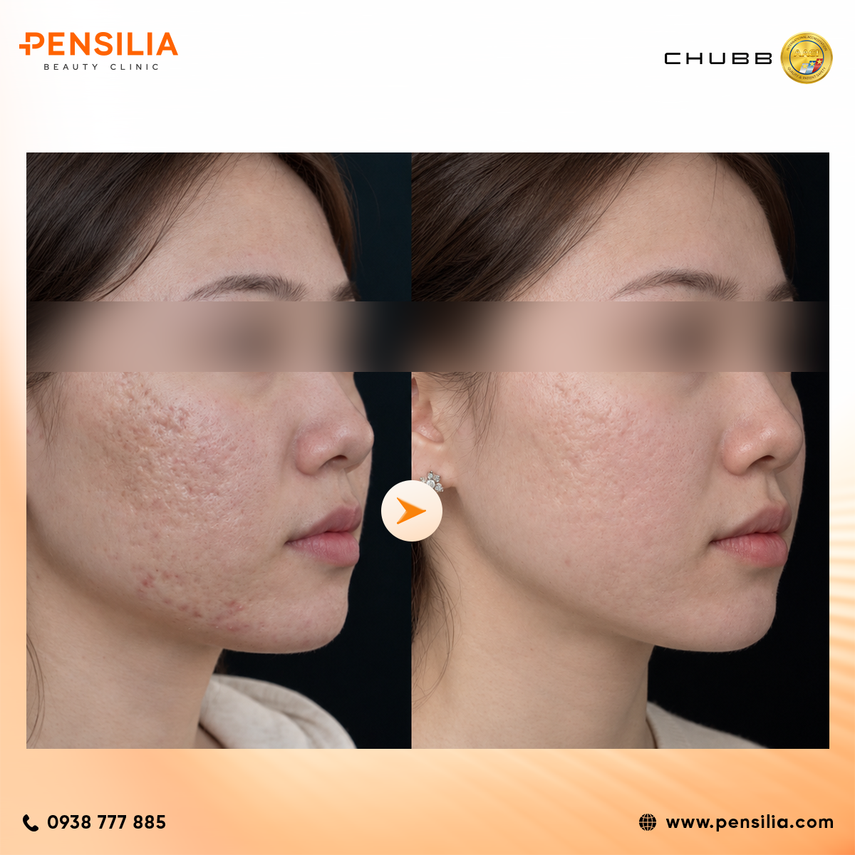 Collagen LineRase sẹo sau mụn