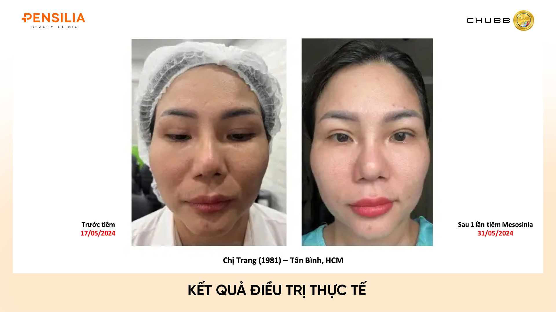 sẹo sau laser INBIOTEC AMBER – "SKIN BUILDER" THẾ HỆ MỚI: PHỤC HỒI DA TỪ GỐC, CĂNG BÓNG TỰ NHIÊN