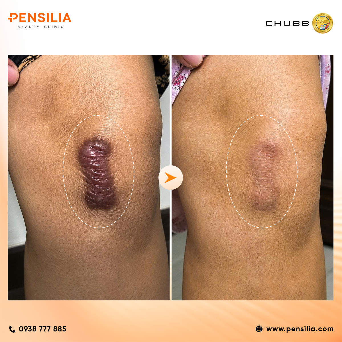 nơi điều trị sẹo lồi tai nạn hcm pensilia