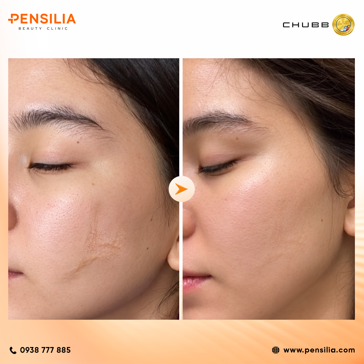 sẹo lồi trên mặt điều trị ở pensilia hcm