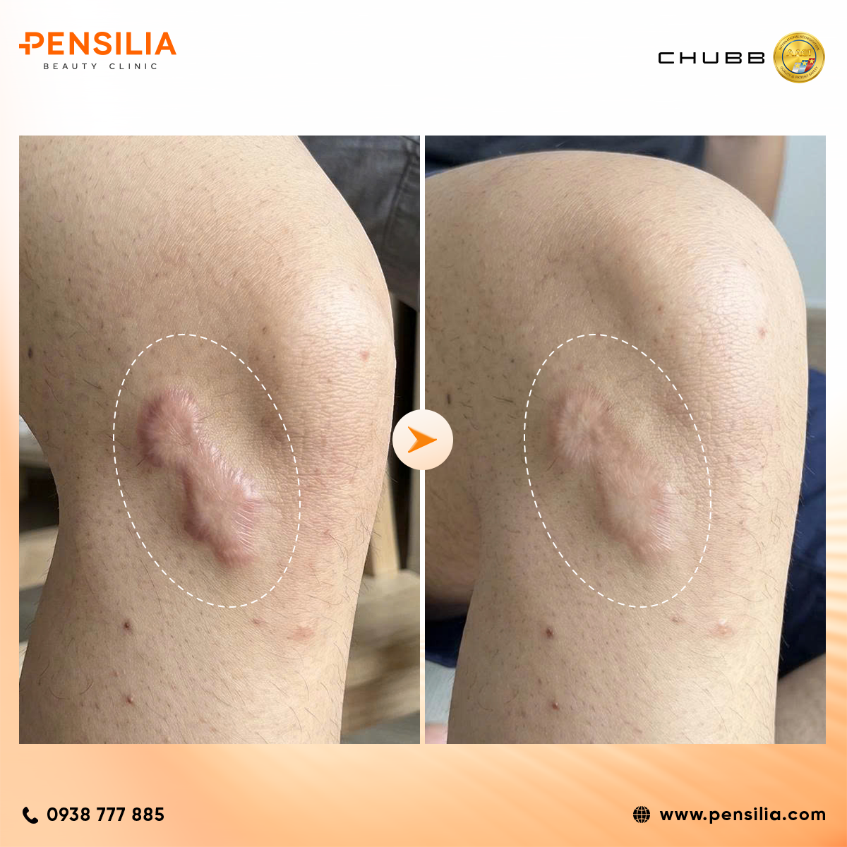 trị sẹo lồi do tai nạn tại pensilia