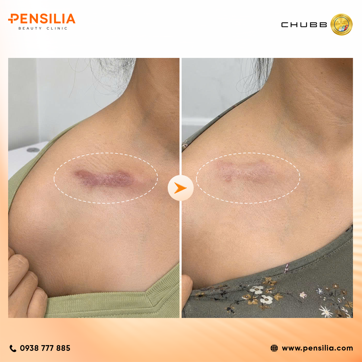 hiệu quả đièu trị sẹo lồi sẹo tai nạn tại pensilia laser 2026