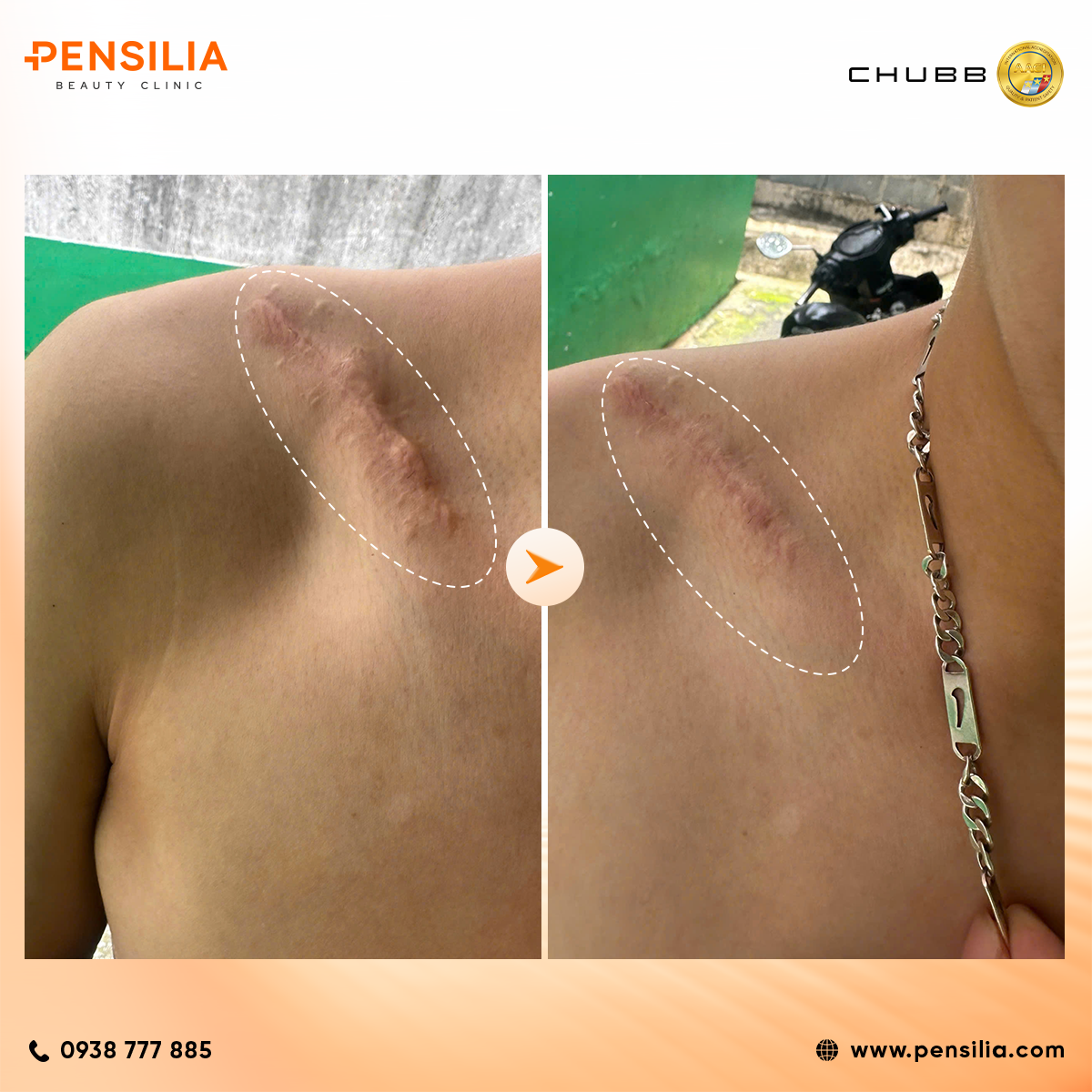 trị sẹo ai nạn hcm pensilia