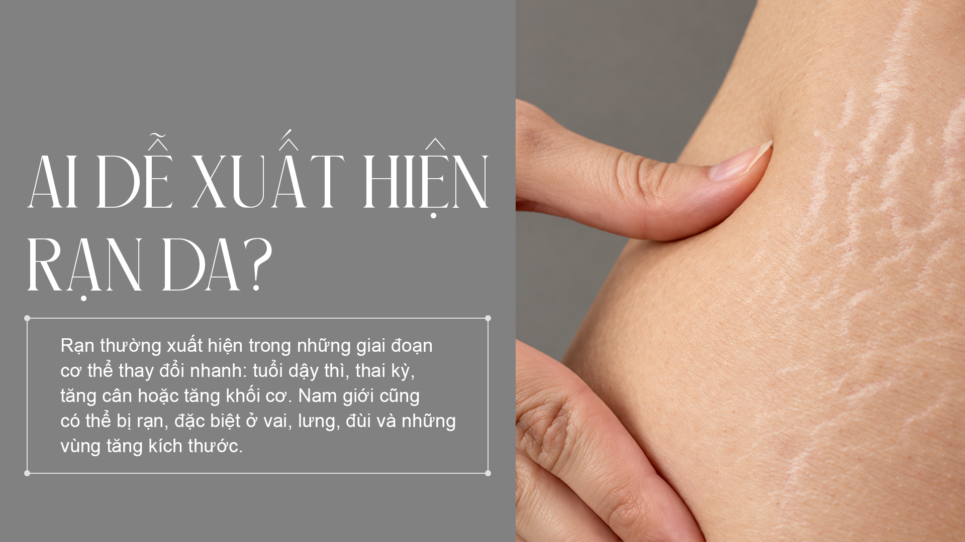 Ai dễ xuất hiện rạn da