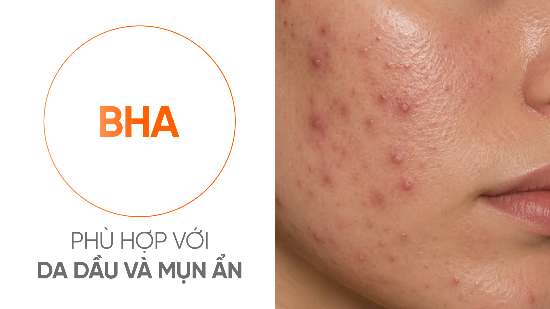 BHA, AHA và Retinol là gì