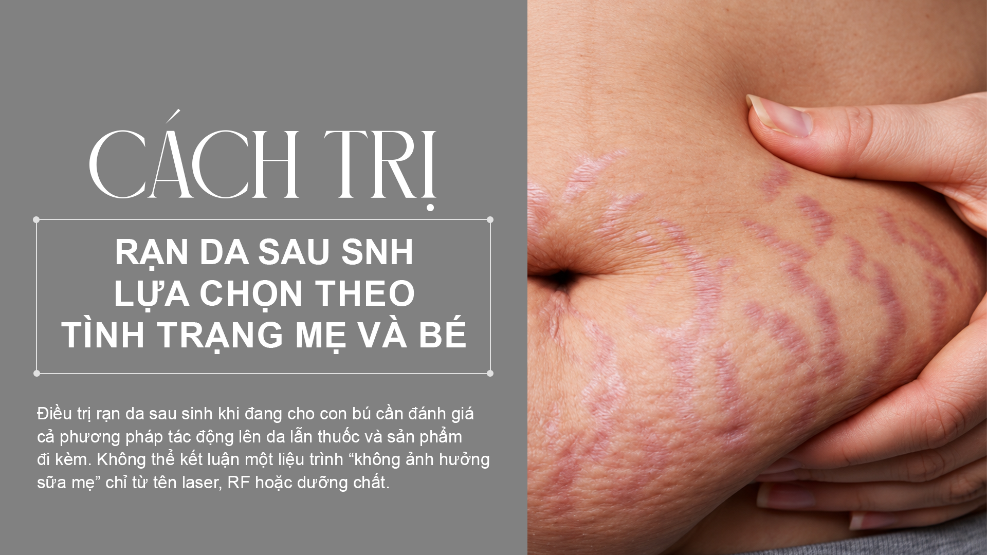 Cách trị rạn da sau sinh khi đang cho con bú