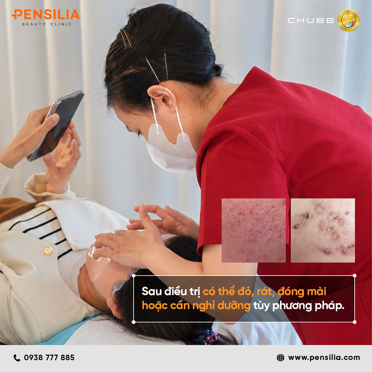 Chăm sóc và làm dịu da sau khi điều trị sẹo rỗ giúp giảm ửng đỏ bong đóng mày