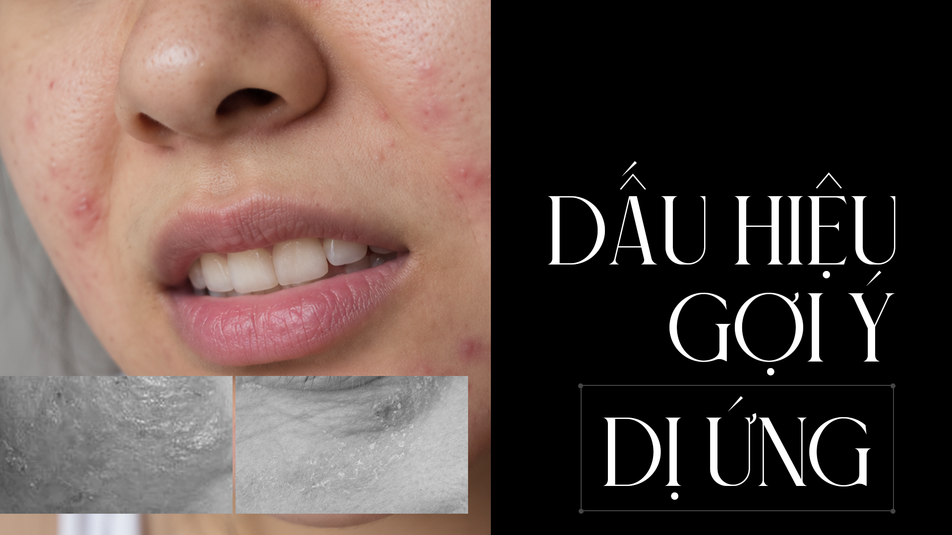 dấu hiệu dị ứng Kích ứng và dị ứng mỹ phẩm khác nhau thế nào