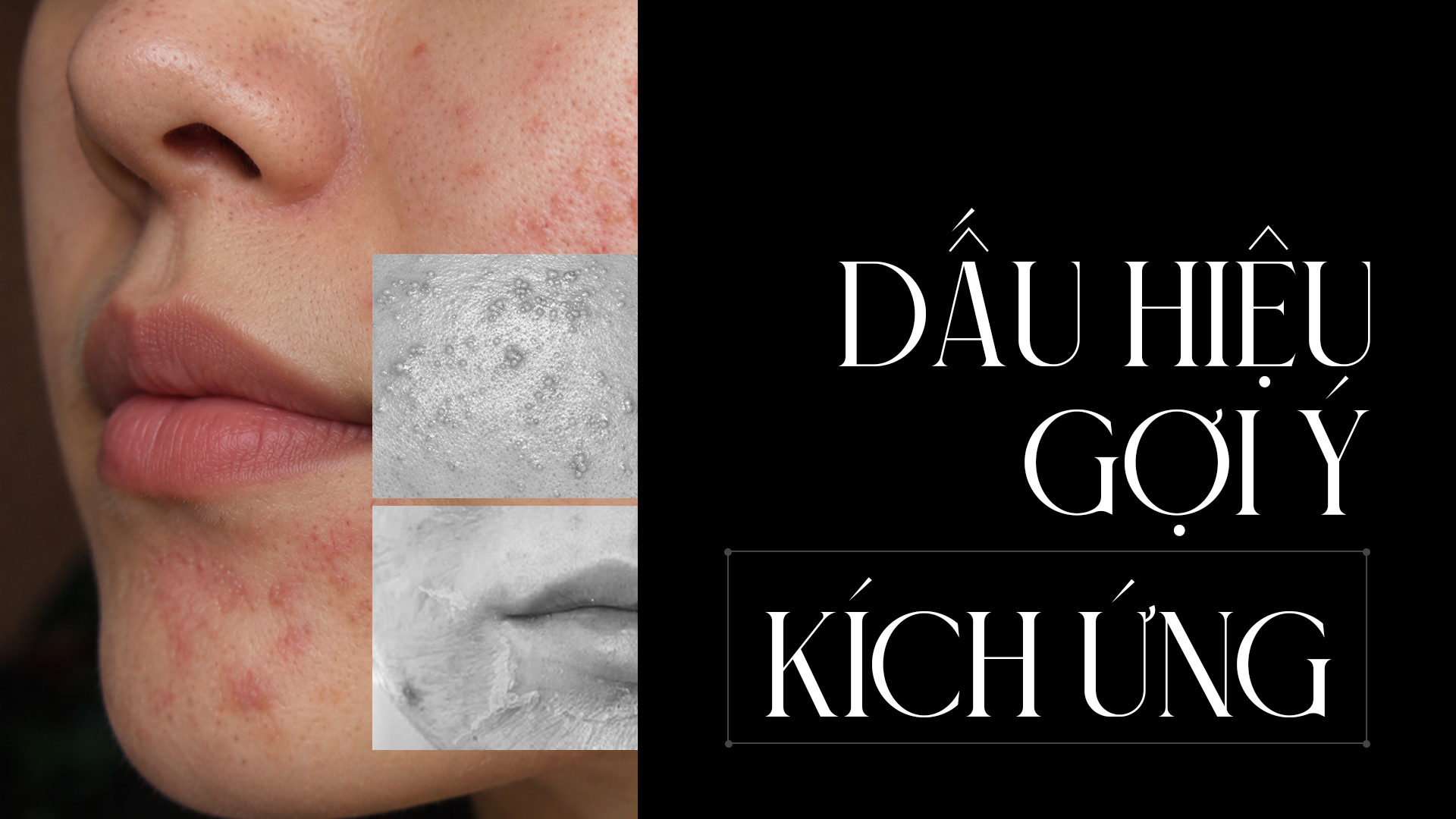 dấu hiệu kích ứng Kích ứng và dị ứng mỹ phẩm khác nhau thế nào