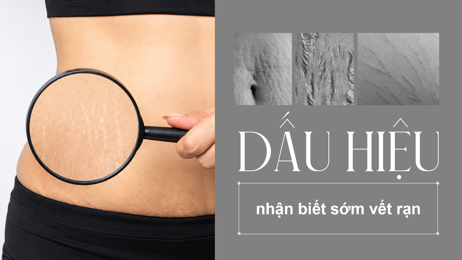 Dấu hiệu nhận biết sớm vết rạn