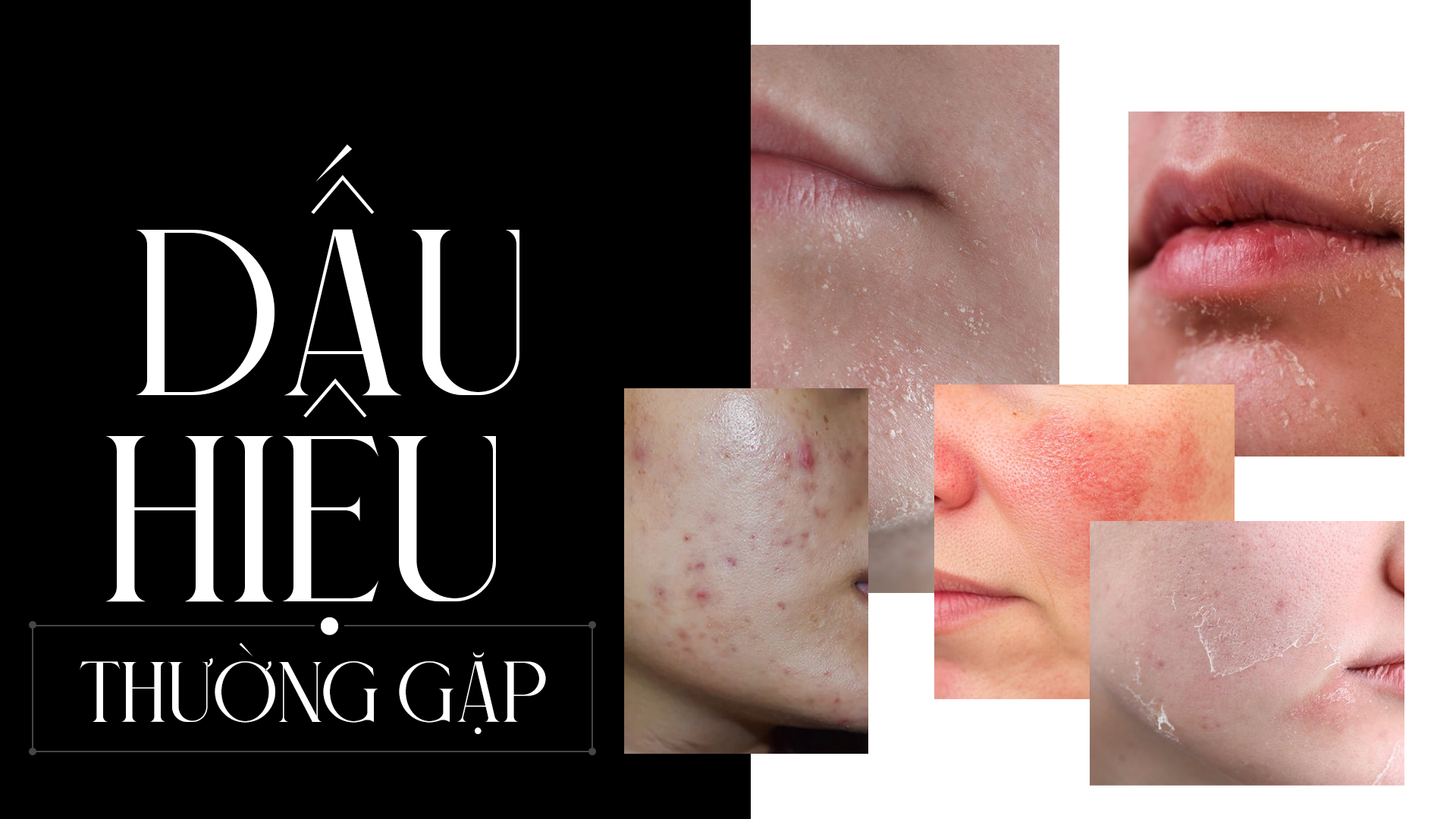 dấu hiệu Hàng rào bảo vệ da bị tổn thương