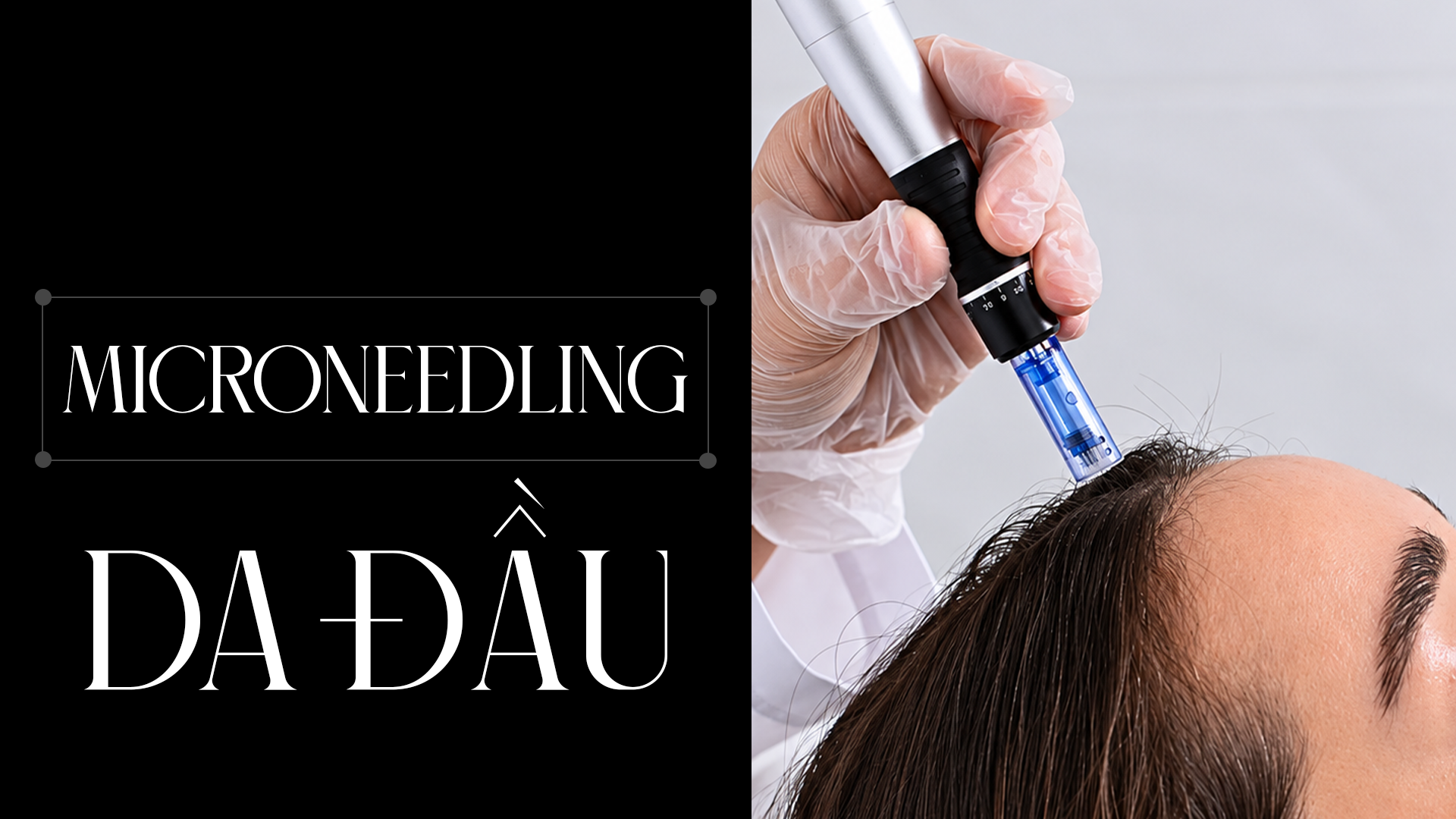 Microneedling da đầu