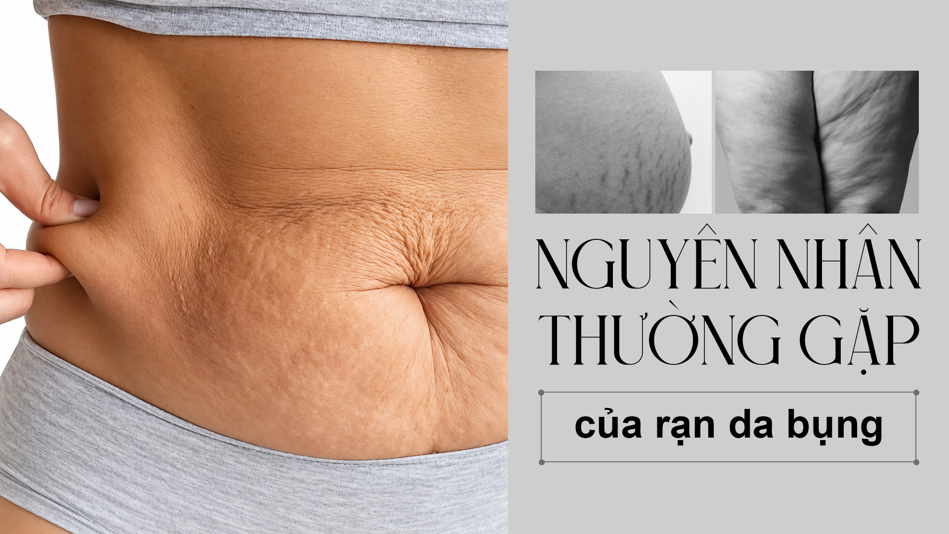 Nguyên nhân thường gặp của rạn da bụng